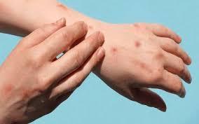 لاہو ر میں منکی پاکس کا خطرہ سنگین،مزید 4 نئے کیسز رپورٹ