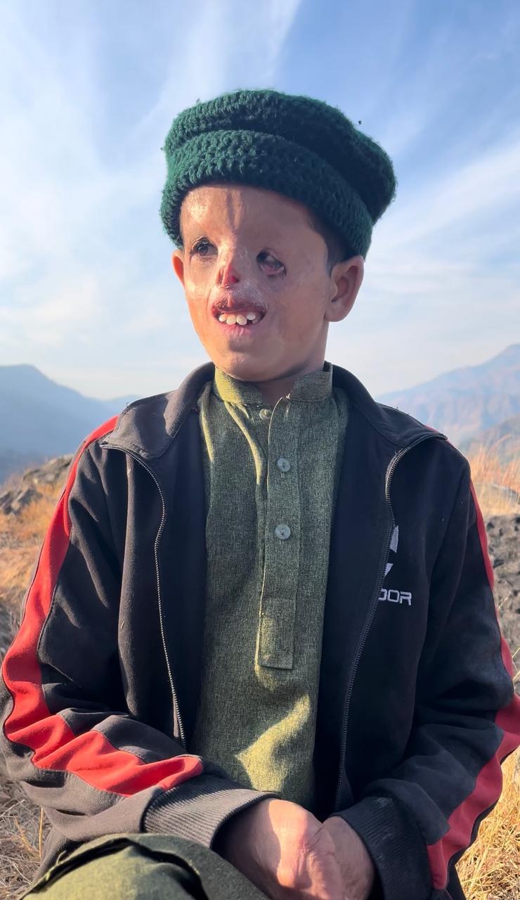 ایک ننھا چہرہ، ایک بڑی آزمائش، آزاد کشمیر کا نوجوان سعد علاج کا منتظر